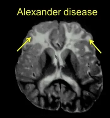 Alexanders disease Radiology