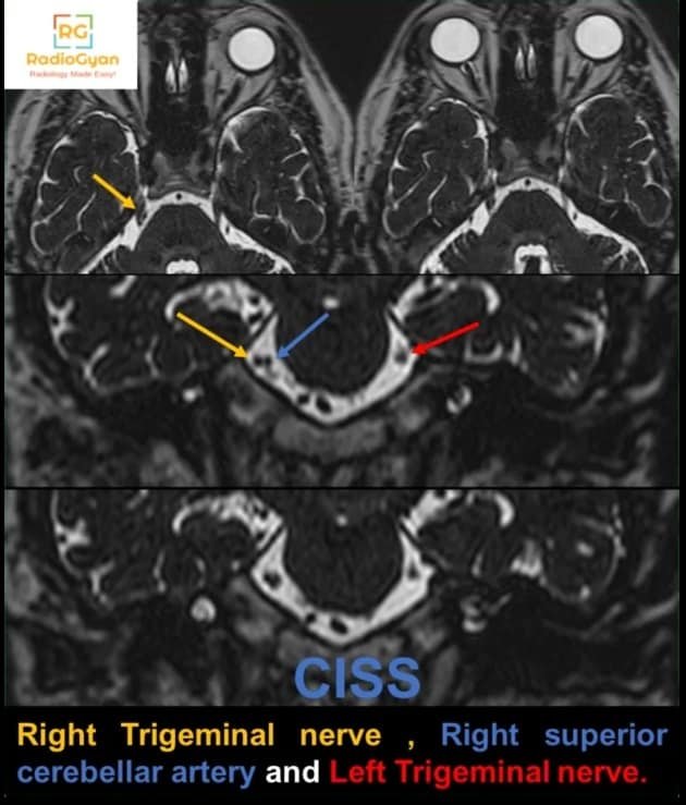 Trigeminal Neuralgia MRI CISS image 