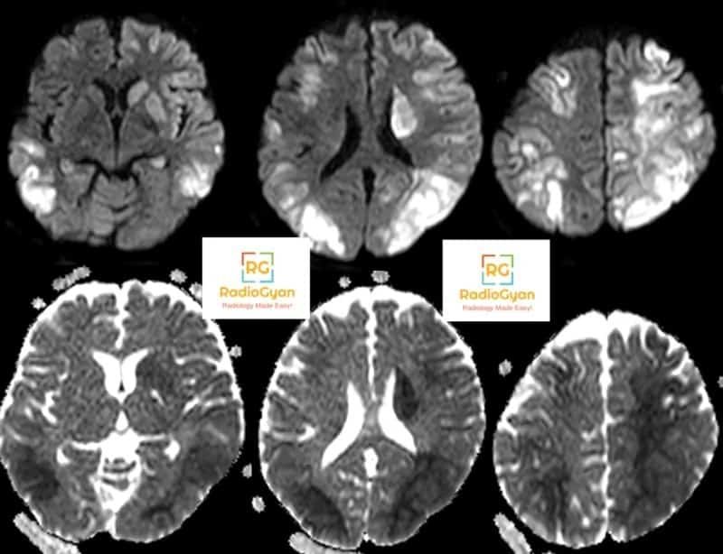 Hypoxic ischemic encephalopathy DWI and ADC MRI images