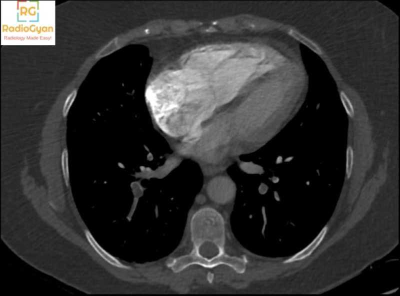 Pulmonary embolism diagnosis : What MORE does the radiologist need to report! 