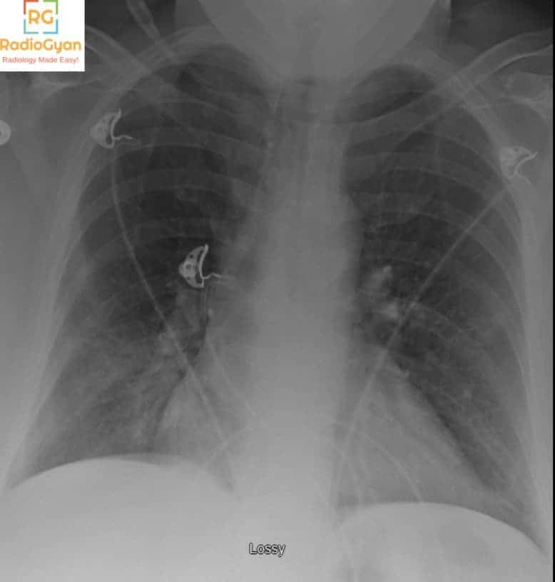 Pulmonary embolism diagnosis : Palla sign