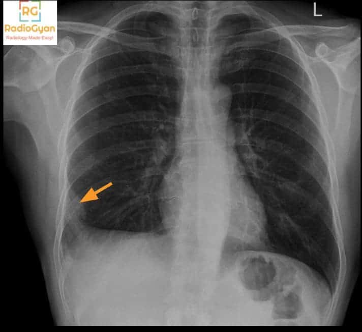 Pulmonary embolism diagnosis : Hampton Hump