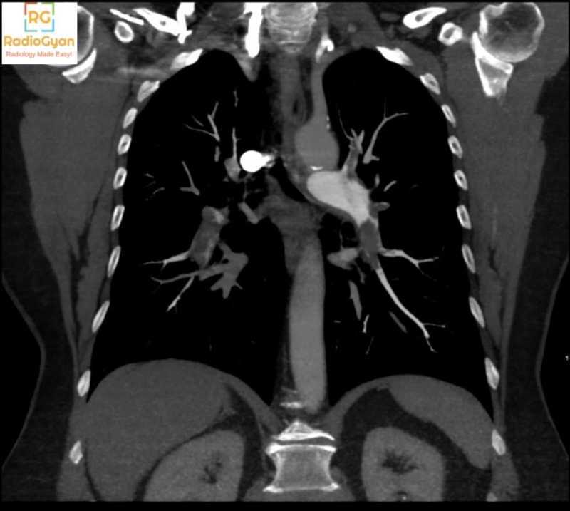 Pulmonary Embolism Diagnosis: Coronal MIP