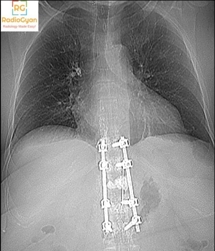 Pulmonary embolism diagnosis : Quiz case