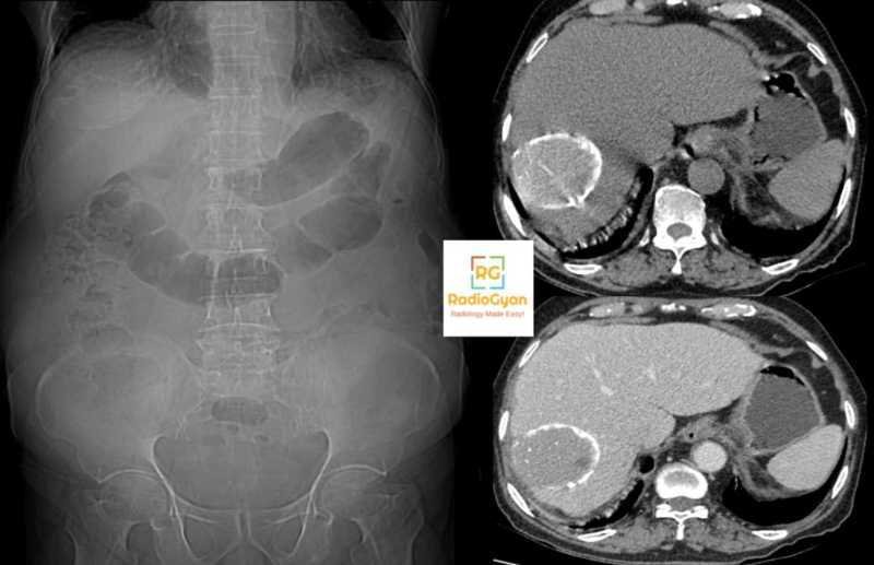 Hydatid cyst Radiology Cases Quiz