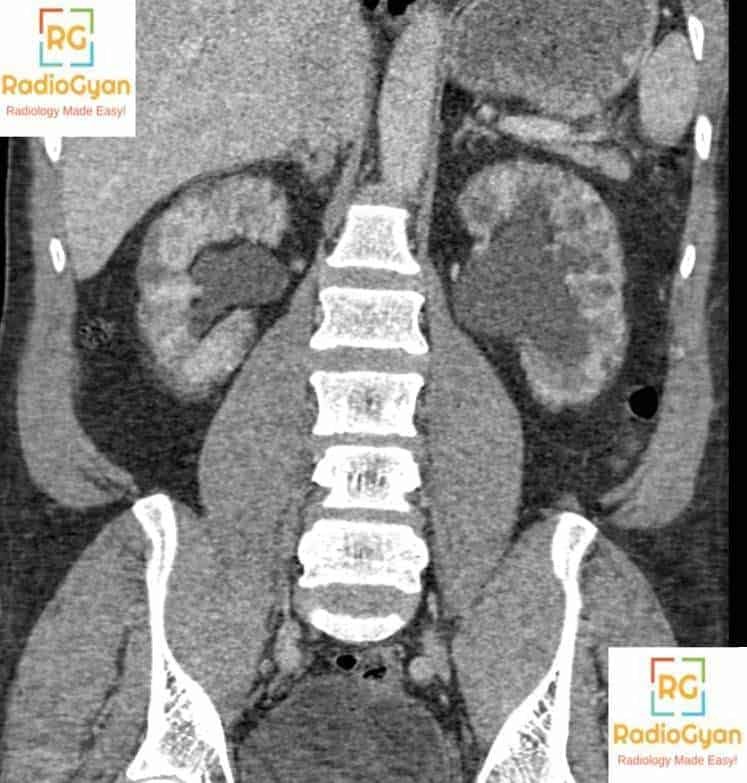 CT coronal image showing lithium nephropathy cysts