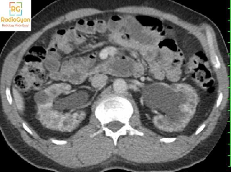 CT axial  image showing lithium nephropathy cysts