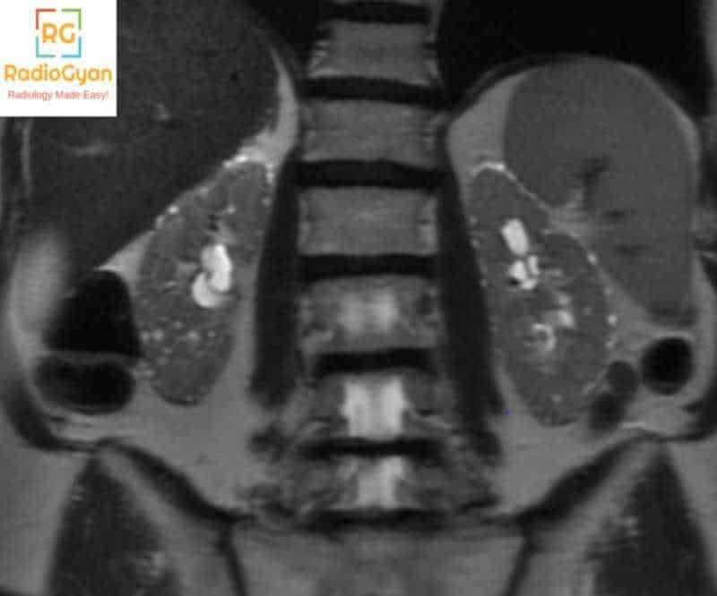 Lithium Nephropathy MRI coronal view