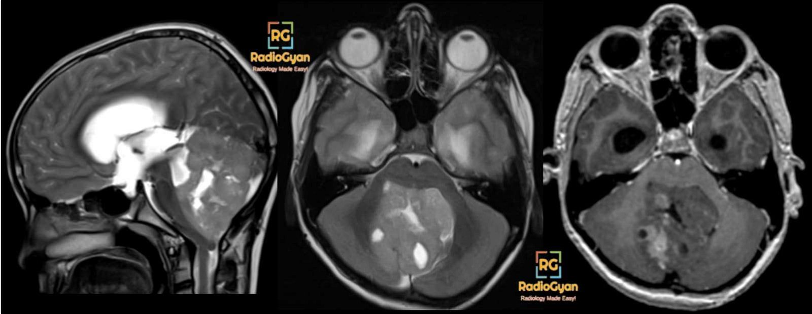 Medulloblastoma Classic radiology cases