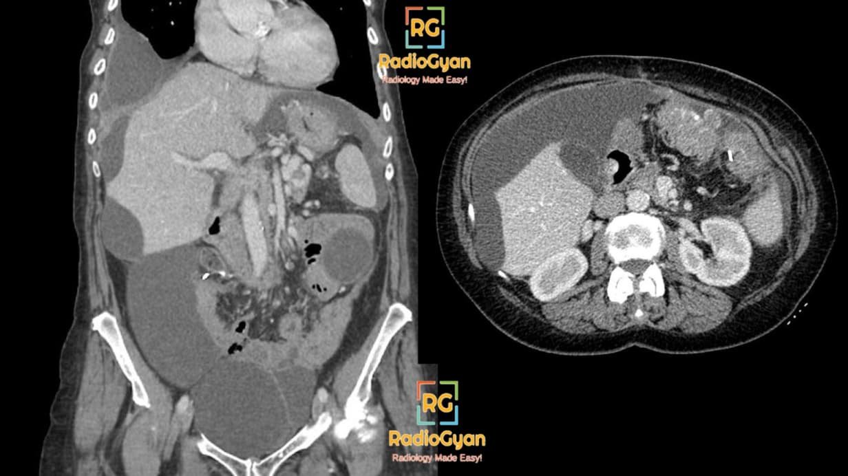 CT scan of a classic radiology case showing pseudomyxoma peritonei