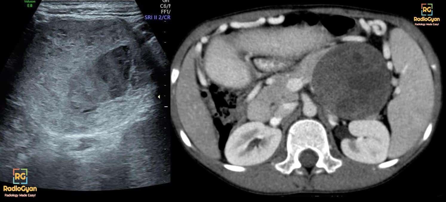 Ultrasound and CT image of a SPEN tumor of the pancreas