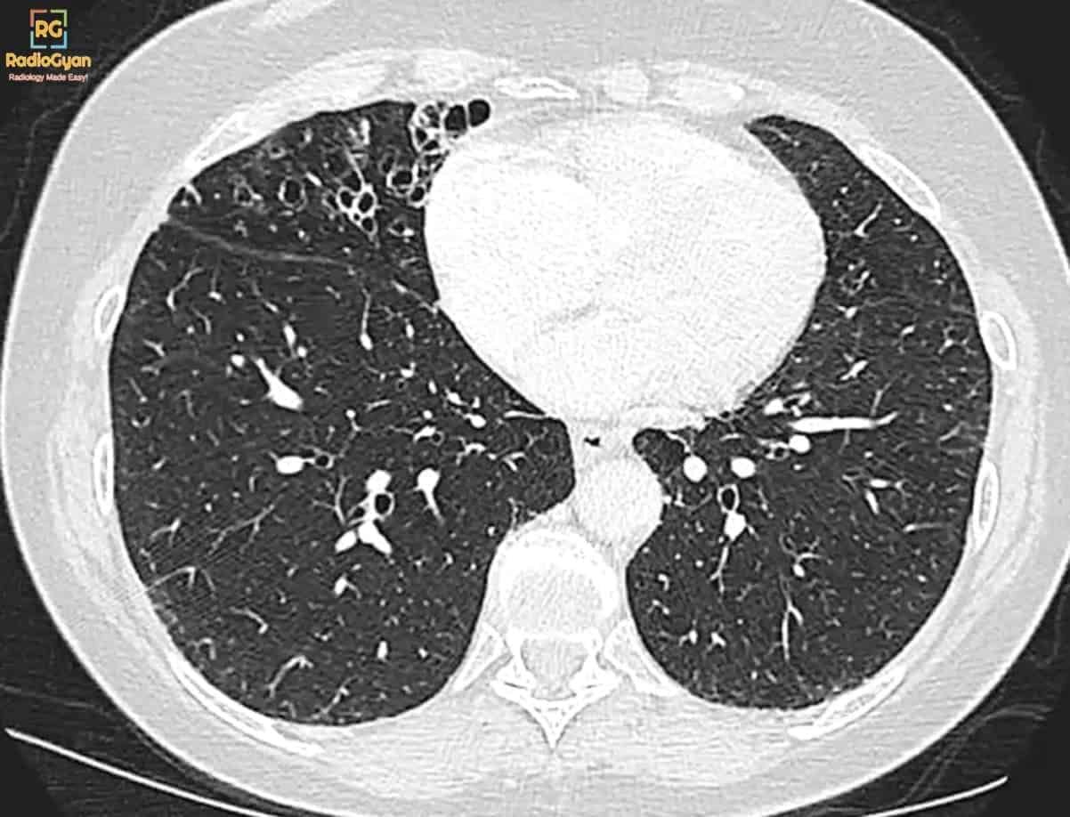 Lady Windermere syndrome radiology findings and imaging approach to bronchiectasis