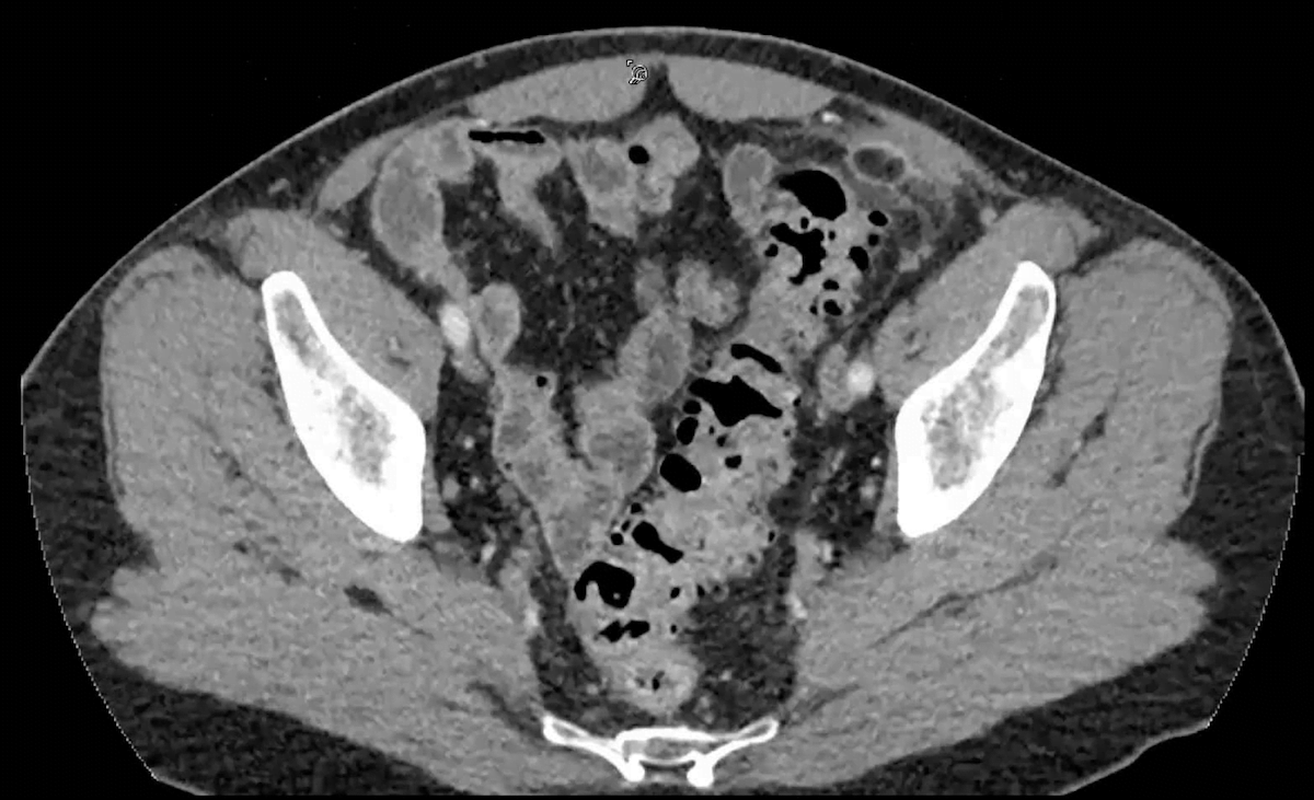 acute epiploic appendagitis radiology features