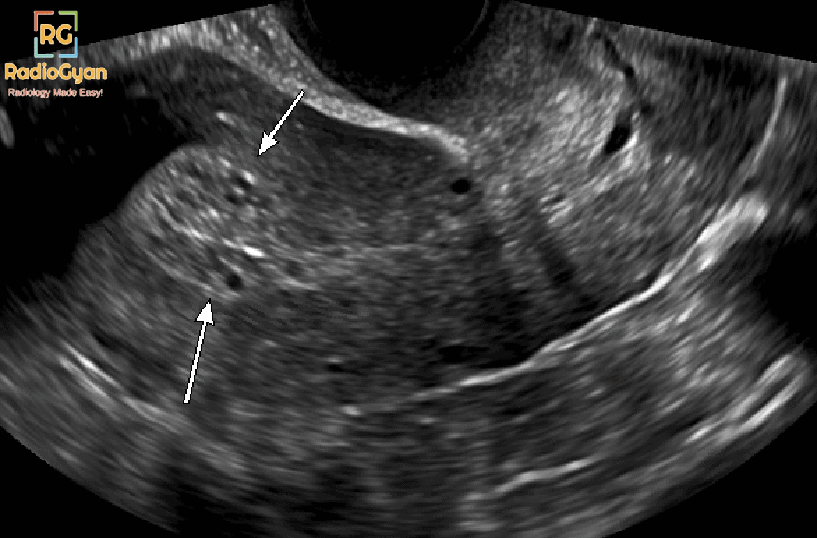 Tamoxifen associated cystic endometrial hyperplasia on Transvaginal ultrasound