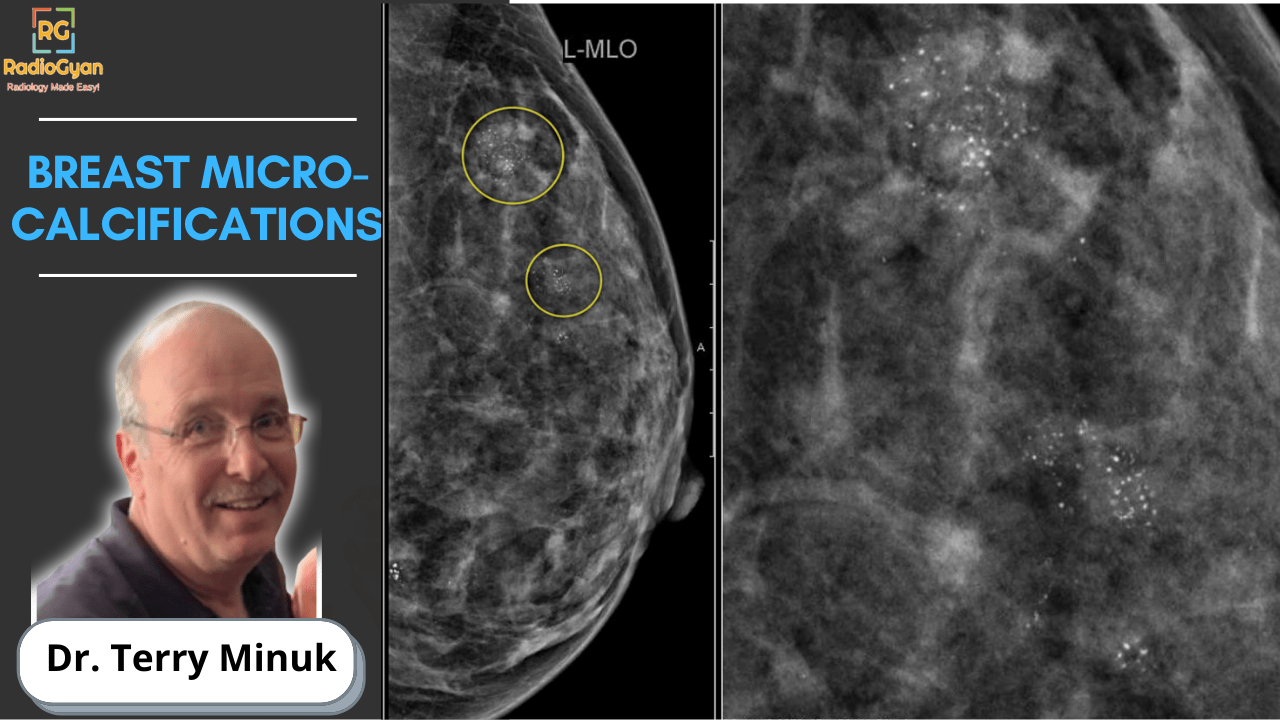 Breast Microcalcifications mammography lecture