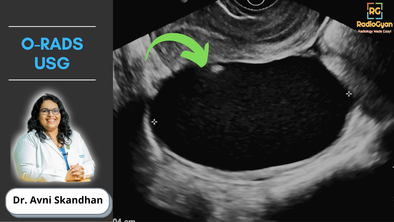 ORADS ultrasound for adnexal cysts