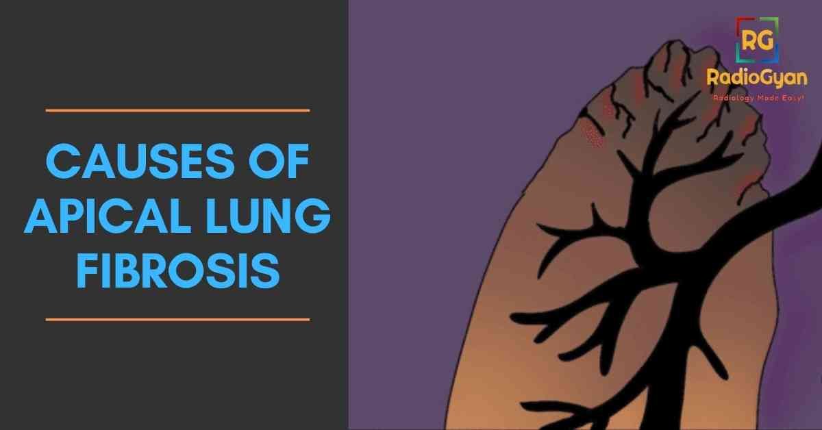 Causes of apical lung fibrosis