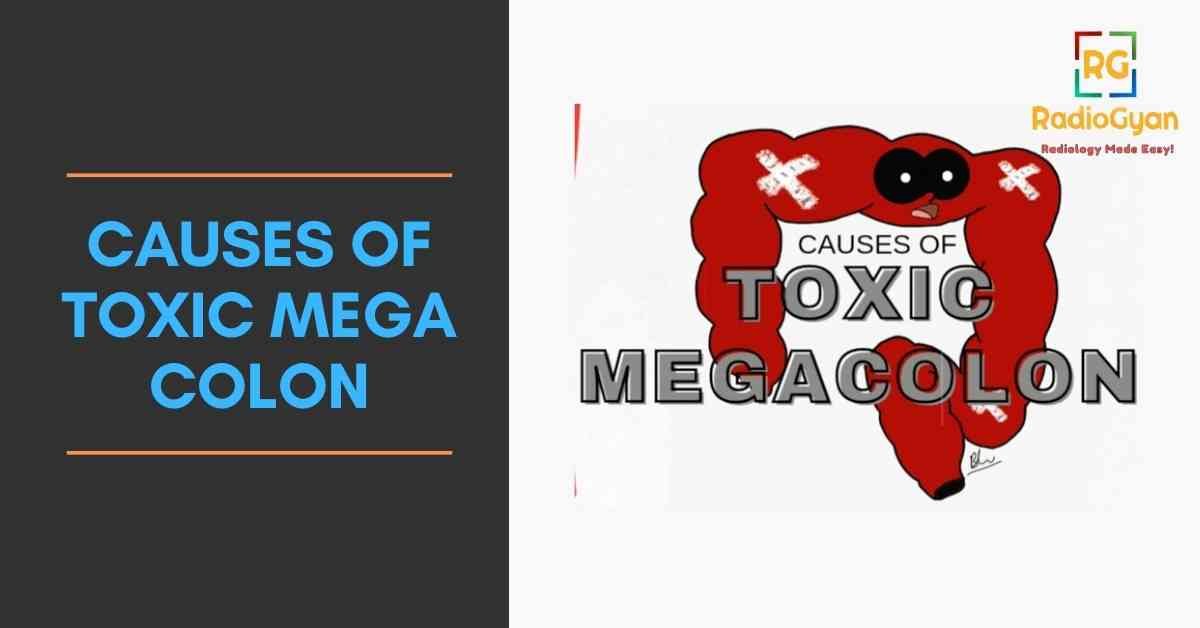 Causes Of Toxic Megacolon