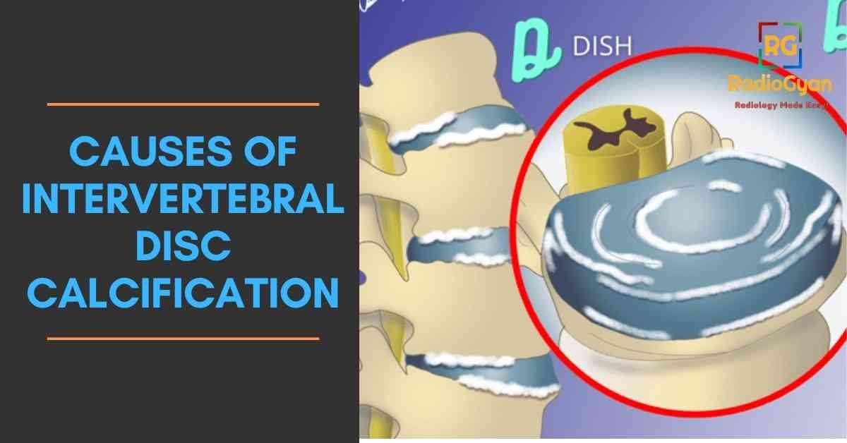 causes of Intervertebral disc calcification