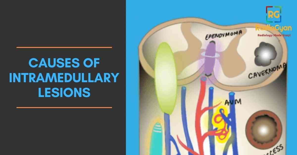 causes of Intramedullary Lesions