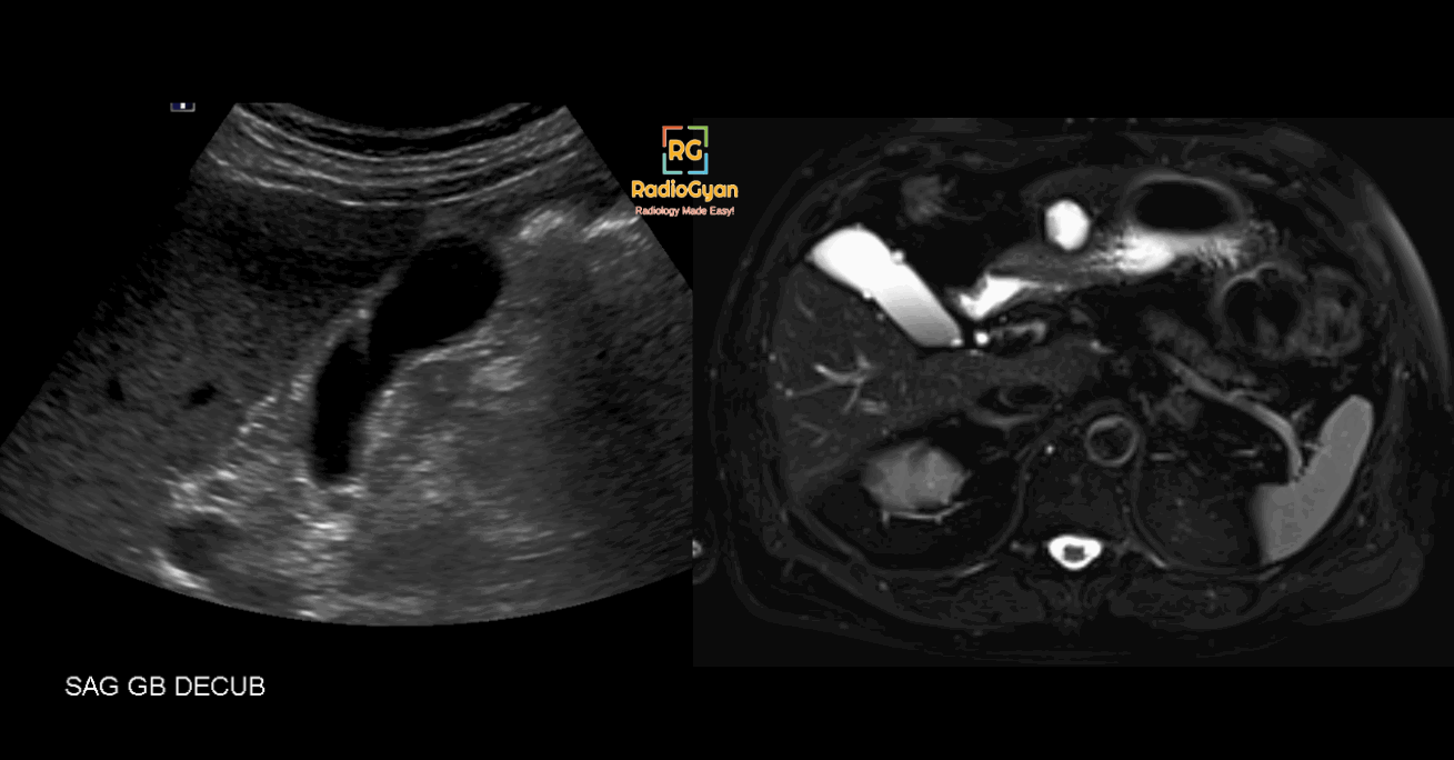 Adenomyomatosis Ultrasound