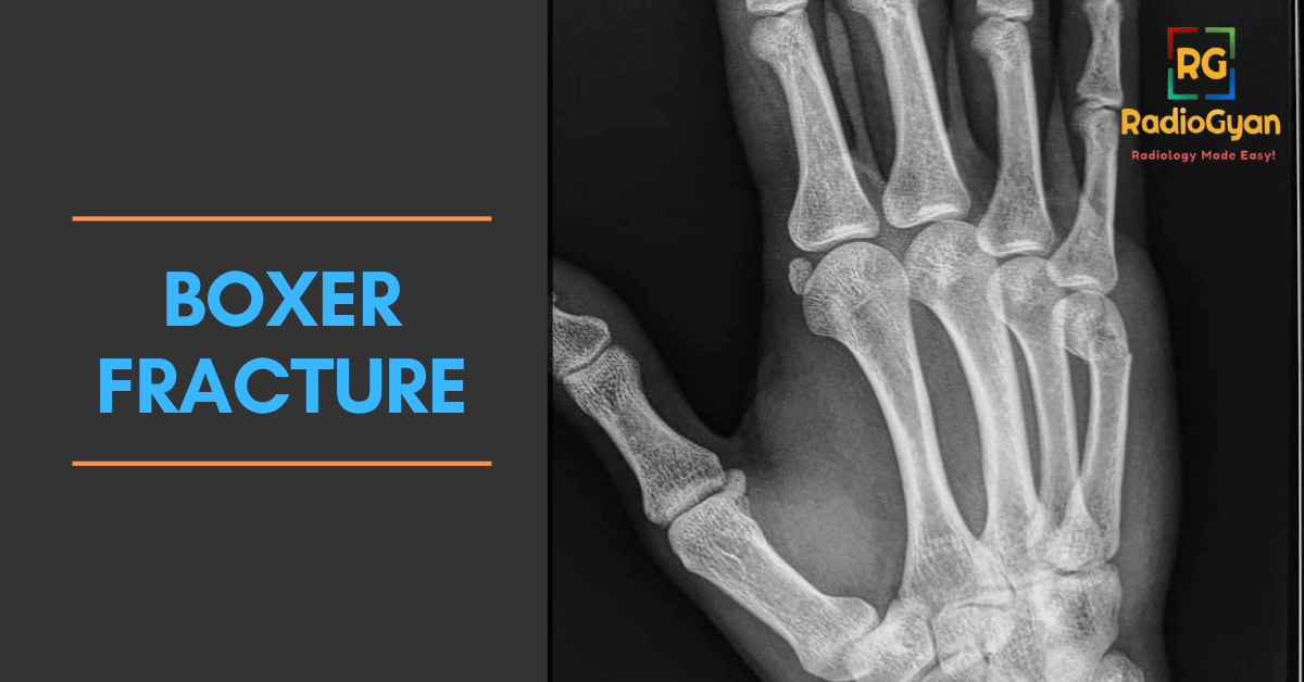 Boxer's fracture Radiograph