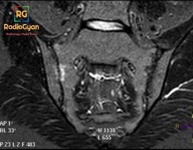 MRI STIR Image showing subchondral bone marrow edema in Sacroiliitis