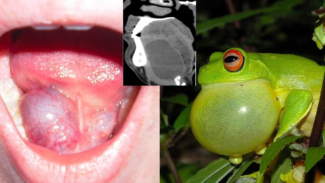 Ranula CT and clinical appearance and comparison with a frog's vocal sac