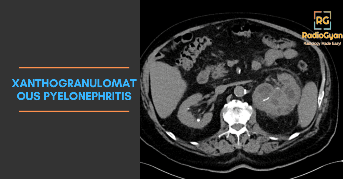 Xanthogranulomatous Pyelonephritis CT