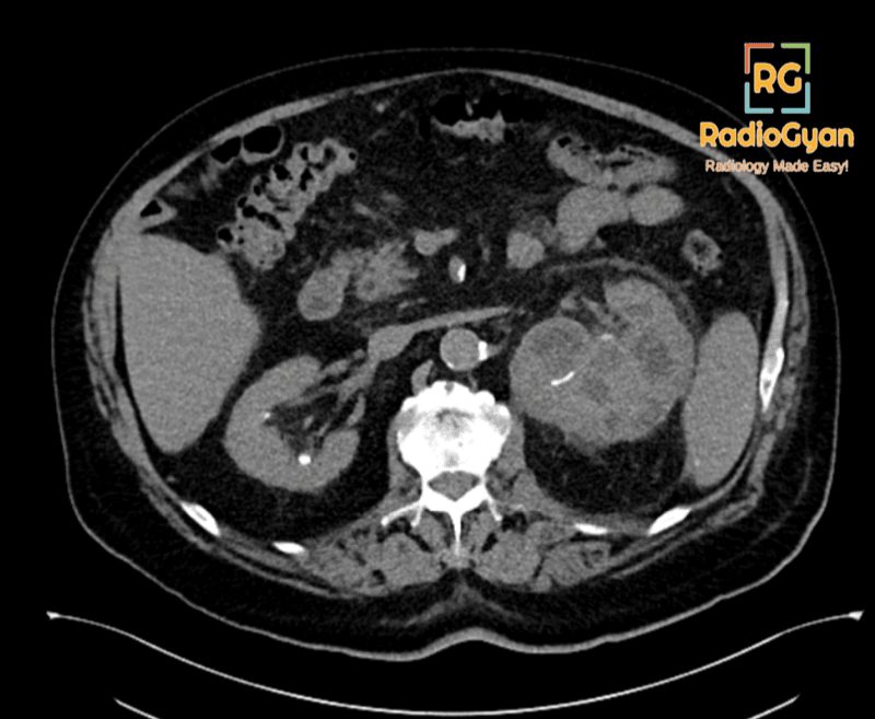 Xanthogranulomatous pyelonephritis CT Image 