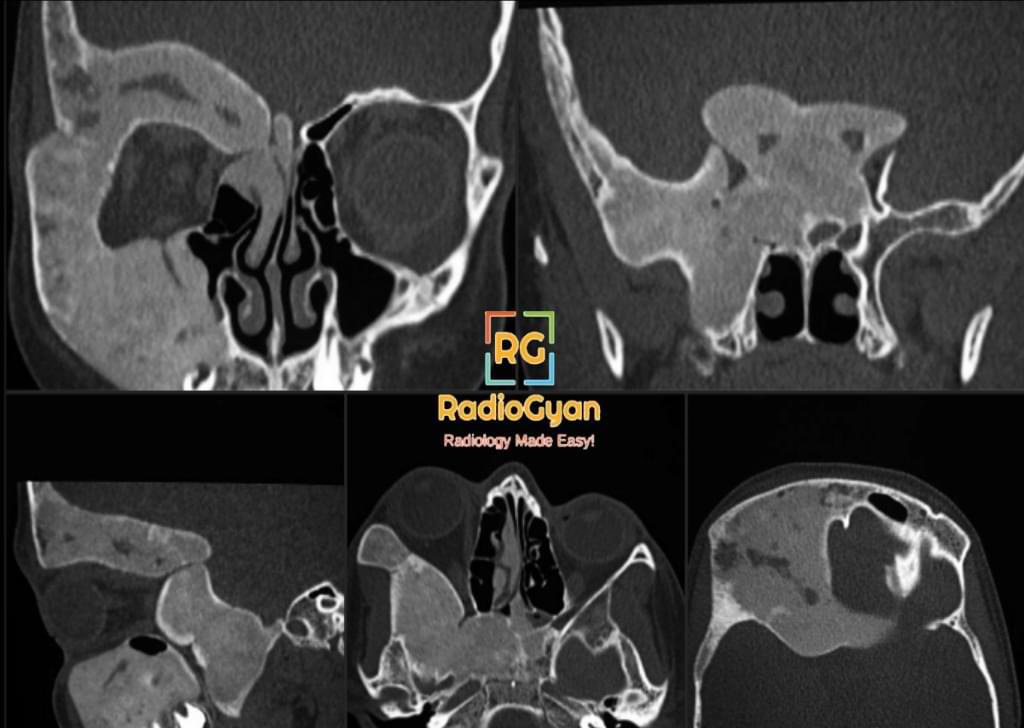 Craniofacial fibrous dysplasia CT Image