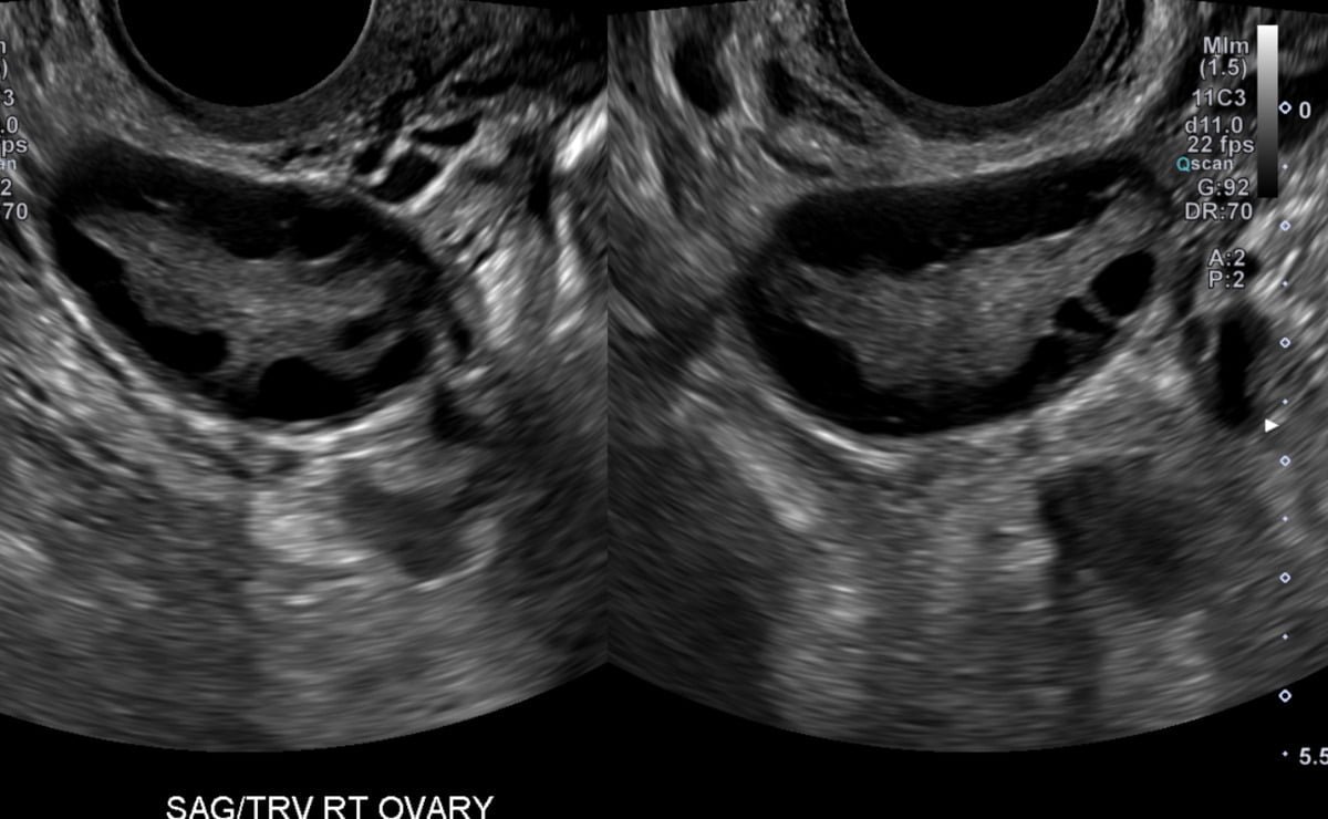Polycystic Ovary PCOS PCOD Transvaginal Ultrasound