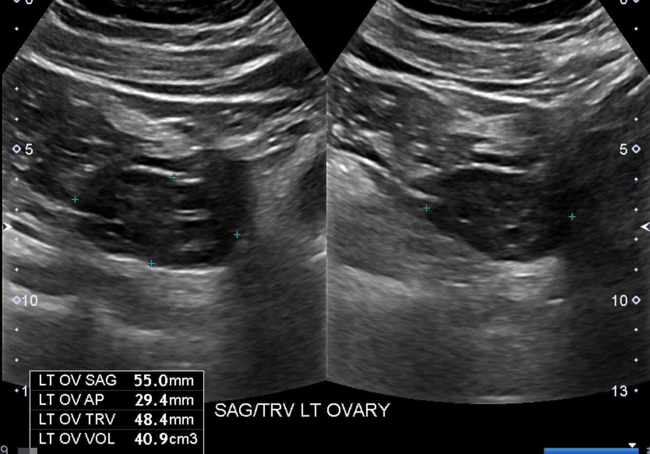 Polycystic Ovary PCOS PCOD Ultrasound