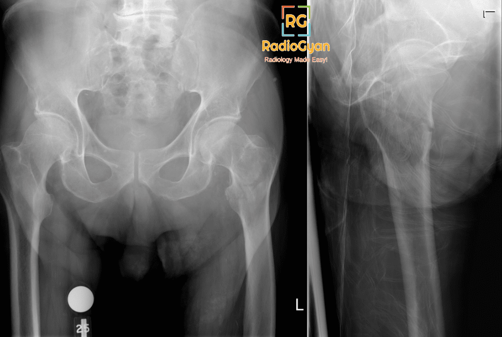 Left femoral intertrochanteric fracture radiograph