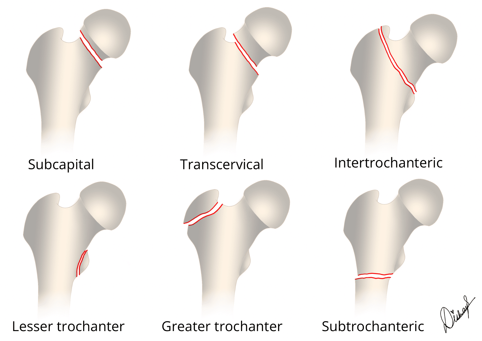 Proximal Femoral fractures classification subtypes - labelled image