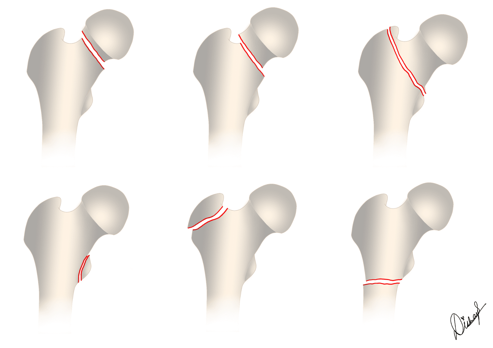 Proximal Femoral fractures classification subtypes quiz image