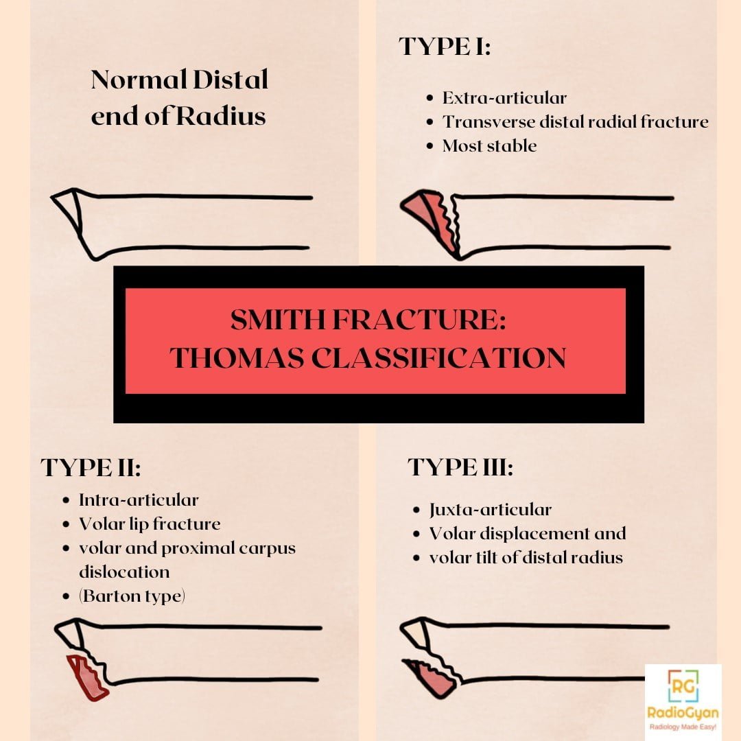 Classification system for Smiths fracture. 