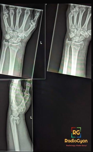 Smith Fracture Radiology Case