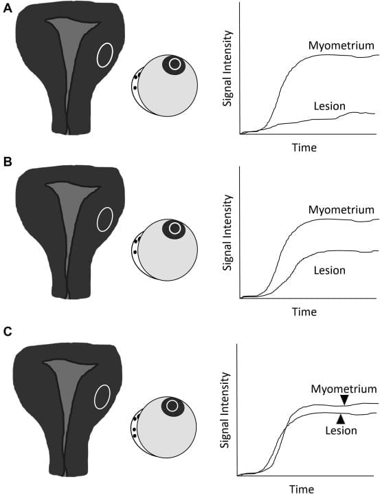 Normal Ovary