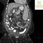 Cirrhosis and Portal Hypertension Radiology Case