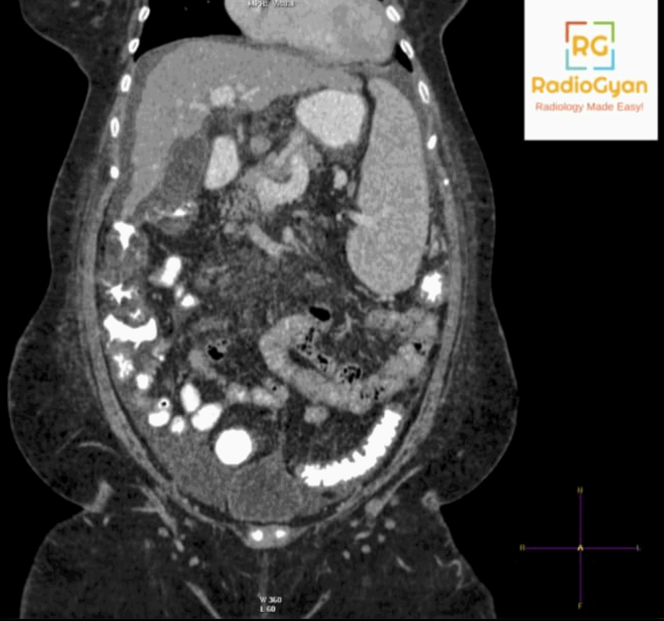 Cirrhosis and Portal Hypertension Radiology Case