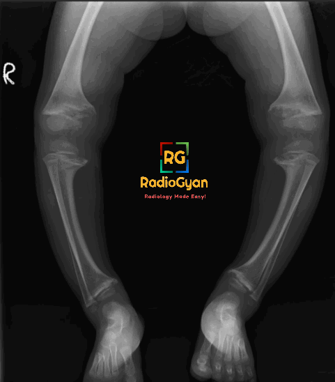 Radiograph of a child showing typical imaging features of rickets: bowing, metaphyseal cupping, splaying, and fraying