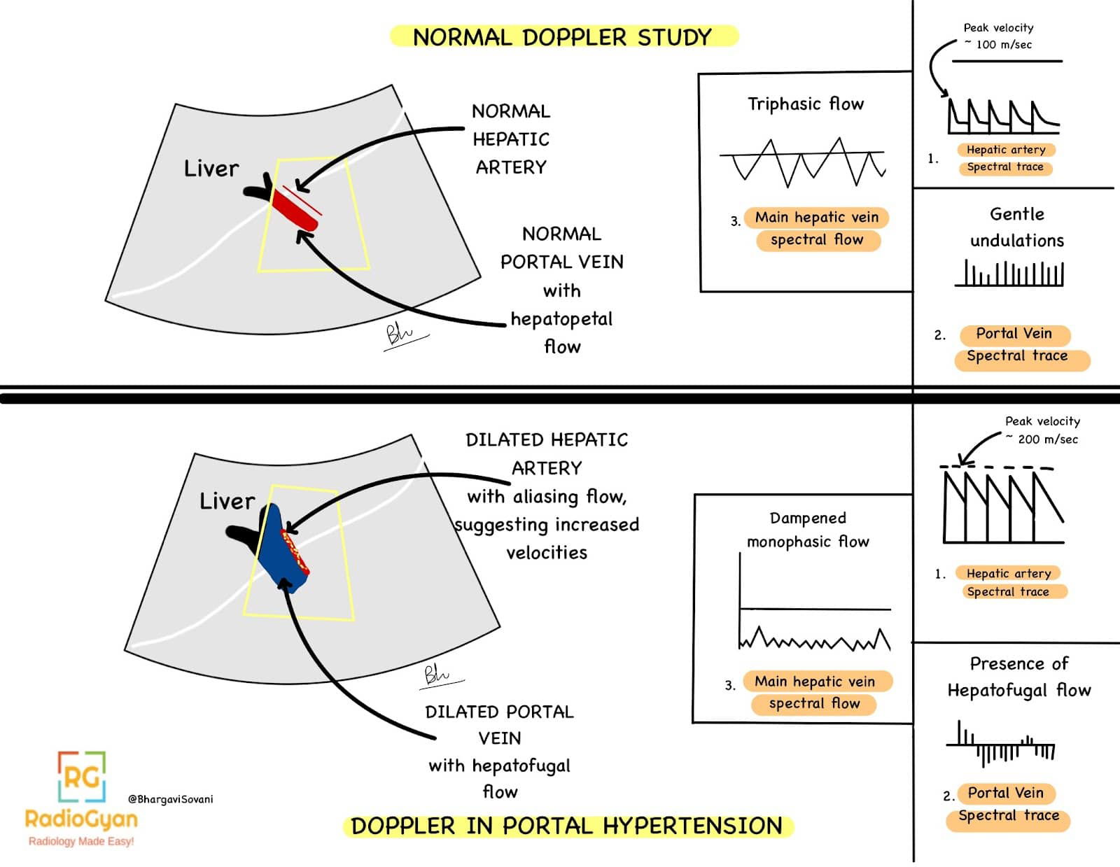 Schematic of Doppler study showing spectral traces in hepatic artery, hepatic vein, and portal vein under normal conditions and with portal hypertension.