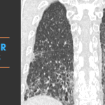 Usual Interstitial Pneumonia and other radiology cases