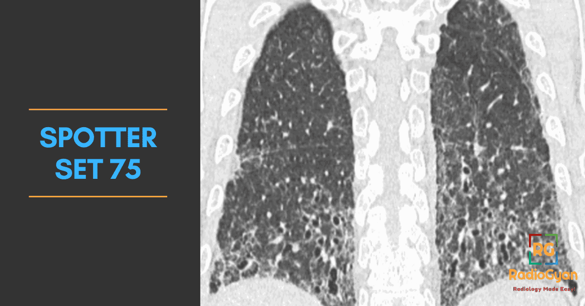 Usual Interstitial Pneumonia and other radiology cases